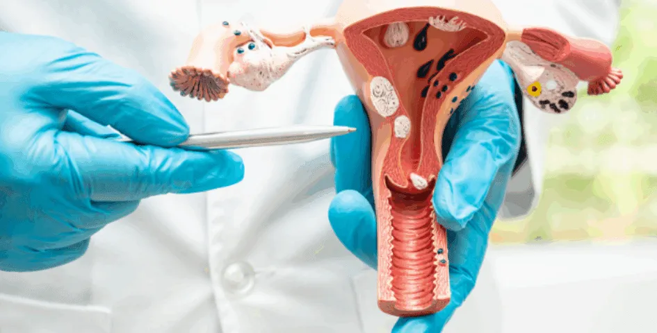 Fibroids & Infertility