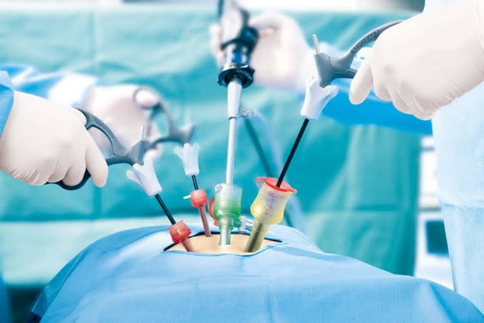 Laparoscopic Surgery for Infertility